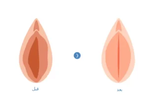 تنگی واژن با لیزر