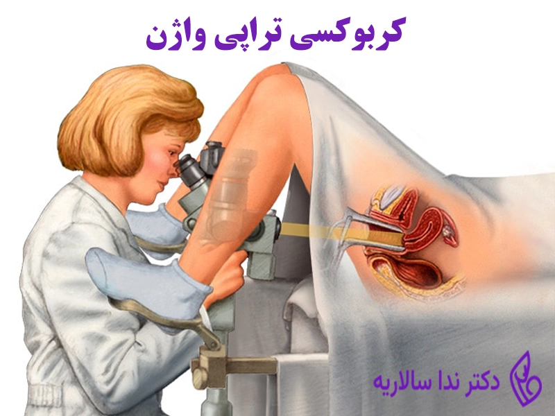 کربوکسی تراپی واژن